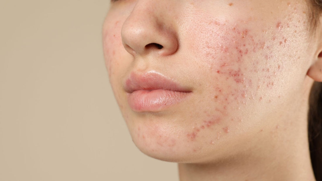 Sivilce Çıkma Aşamaları ve Mineaderm ile Kusursuz Cilt Rehberi